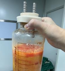 合肥水动力吸脂手术要做多久？